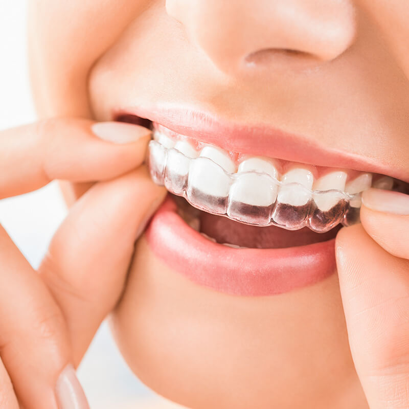 Woman Putting in Clear Retainer